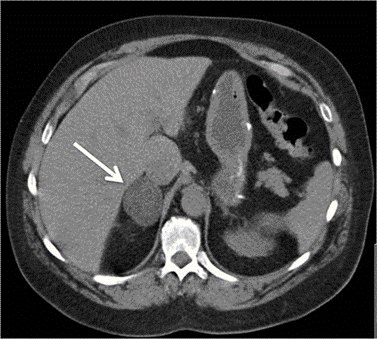 Abdominal CT scan - arrow depicts right adrenal mass