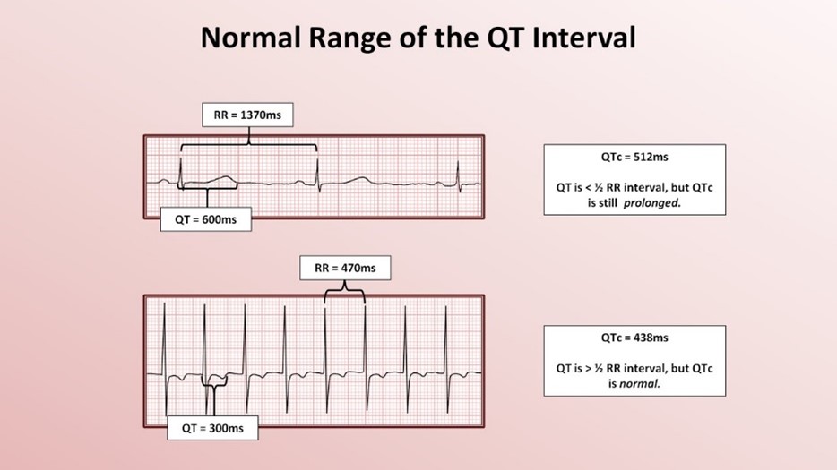 Normal range of the QT interval