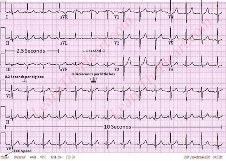 ECG Boxes To Seconds Calculator Definition ECG Values