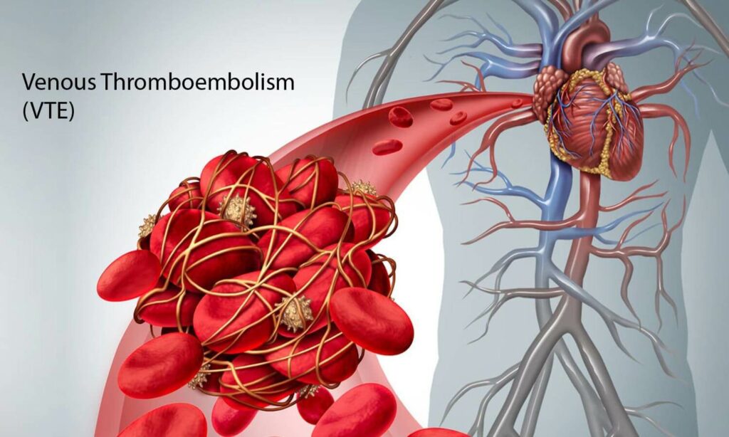 What does Venous Thromboembolism mean in medicine? (PADUA Score)